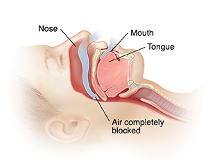 Side view cross section of head showing obstructive sleep apnea.