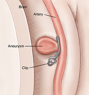 Closeup of small artery showing clip sealing off aneurysm.