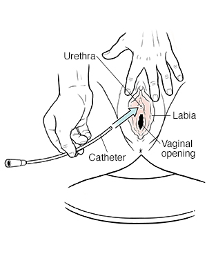 Closeup of vulva showing hands inserting catheter into urethra.