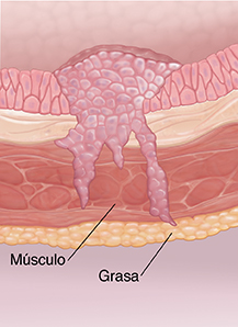 Corte transversal de la pared de la vejiga donde puede verse cáncer en etapa invasiva.