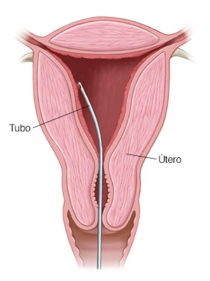 Corte transversal de un cuello uterino con un tubo de biopsia endometrial.