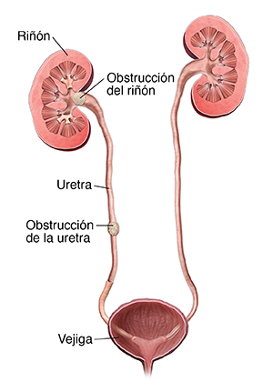 Corte transversal del sistema urinario con piedras en el riñón y el uréter.