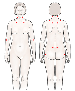 Contorno de un cuerpo donde pueden verse los puntos dolorosos típicos.