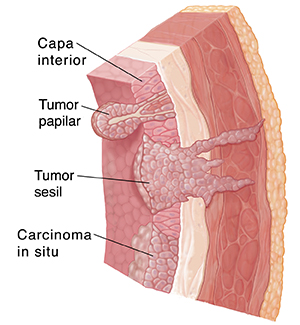 Corte transversal de la pared de la vejiga donde se observa el recubrimiento, la membrana submucosa, el músculo, el tejido adiposo y tres tipos de cáncer: papiloma, tumor sésil y carcinoma localizado o in situ.
