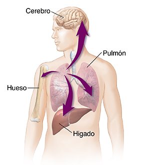 Contorno de figura masculina con flechas que muestran que el cáncer de pulmón se ha propagado al hígado, al otro pulmón, al hueso y al cerebro.