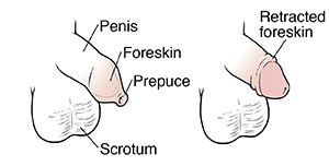 Vista lateral del pene y del escroto de un niño que muestra el prepucio en el pene. Vista lateral del pene y del escroto de un niño que muestra el prepucio retraído.
