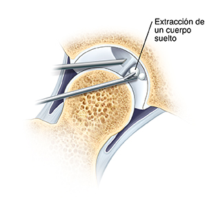 Corte transversal de la articulación de la cadera que muestra la extracción de un trozo de tejido suelto de la articulación con instrumentos artroscópicos. Primer plano del extremo de un artroscopio en la articulación de la cadera y un instrumento que está extrayendo un cuerpo suelto.