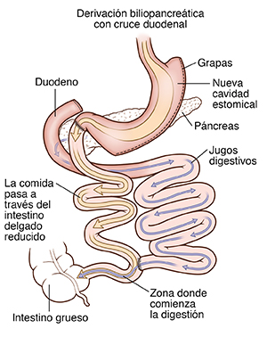 Vista frontal del estómago donde se observa derivación biliopancreática con cruce duodenal. Las flechas indican el recorrido de los alimentos y los líquidos digestivos.