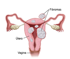 Vista frontal de un corte transversal de un útero con fibromas uterinos.