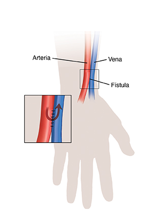 Silueta de una mano y una muñeca, donde se muestra una fístula para hemodiálisis. En el recuadro, se muestra la circulación de la sangre a través de la fístula.