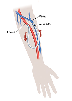 Silueta de una mano y un antebrazo, donde se muestra un injerto para hemodiálisis. Las flechas muestran la circulación de la sangre a través del injerto.