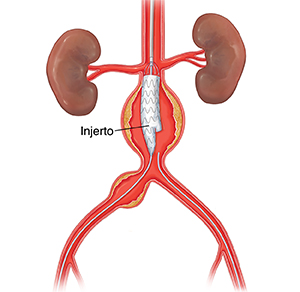 Procedimiento endovascular para colocar injerto para aneurisma aórtico abdominal.
