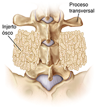 Vista posterior de vértebras lumbares donde se observa un injerto óseo entre las apófisis transversas.