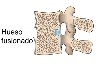 Corte transversal de las vértebras lumbares donde se observa un hueso fusionado entre las vértebras.