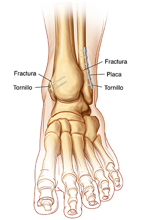 Vista frontal de los huesos del tobillo y del pie donde se observan fracturas de tobillo con fijación interna.