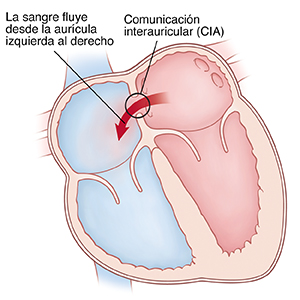 Corte transversal visto de frente de un corazón en donde se ve una comunicación interauricular (CIA) que permite que la sangre pase de la aurícula izquierda a la derecha.