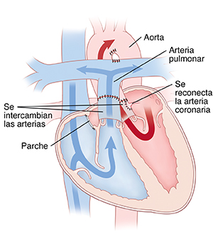 Corte transversal visto de frente de un corazón que muestra la reparación de una transposición de las grandes arterias.