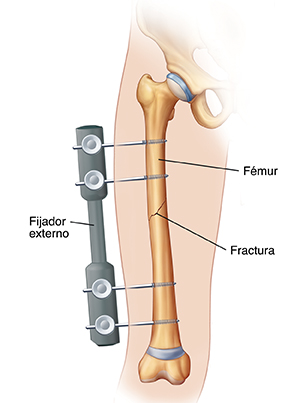 Contorno de una pierna que muestra tornillos que atraviesan la piel hasta el fémur. Los tornillos están conectados al fijador externo afuera de la pierna. El fijador externo mantiene unido el hueso fracturado.