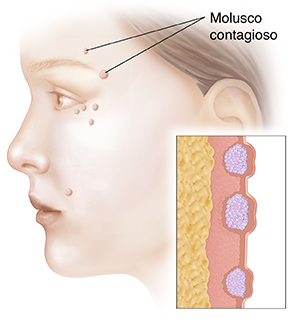 Vista lateral de la cara de una mujer en la que se ve un molusco contagioso. Recuadro que muestra un corte transversal de un molusco contagioso.