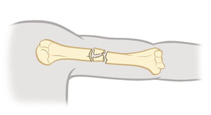 Vista lateral de una fractura por compresión de la columna vertebral.