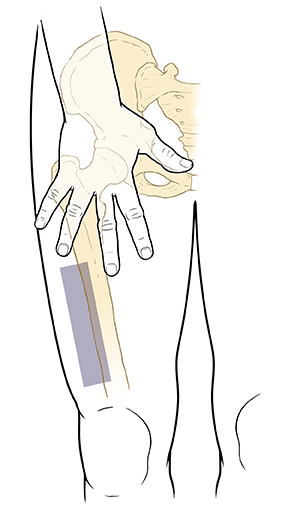 Contorno de la vista frontal de la parte inferior del cuerpo, la cadera y el muslo que muestra los huesos de la pelvis y la pierna. Una mano con los dedos extendidos y la palma hacia abajo frente al muslo donde la pierna se une con el cuerpo. Hay un rectángulo sombreado debajo de la mano y arriba de la rodilla, hacia un lado de la pierna.
