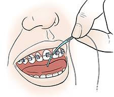 Primer plano de una boca en donde se ve una mano que ubica el hilo dental entre los dientes con un enhebrador.