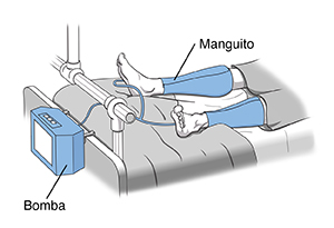 Paciente en cama de hospital utilizando mangas de compresión secuencial en las piernas.