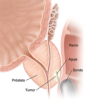 Corte transversal de una próstata y recto donde puede verse una biopsia de próstata por punción de aguja.