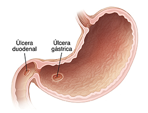 Corte transversal del estómago donde pueden verse una úlcera gástrica y una úlcera duodenal.
