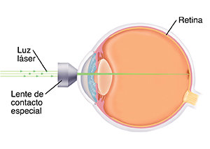 Vista lateral de un ojo que muestra la lente en el frente del ojo. Una luz láser se enfoca en la pared trasera interna del ojo. 