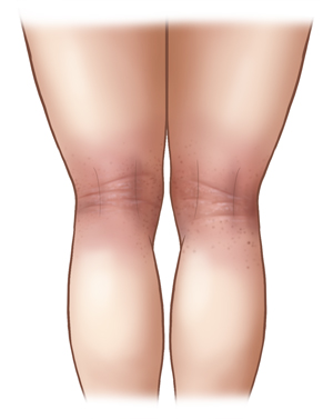 Vista posterior de piernas con dermatitis en los pliegues de las rodillas.