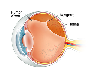 Corte transversal de tres cuartos de un ojo donde se observa el vítreo desprendido que está provocando el desprendimiento de retina.