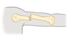 Parte superior del brazo donde se observa una fractura segmentaria.