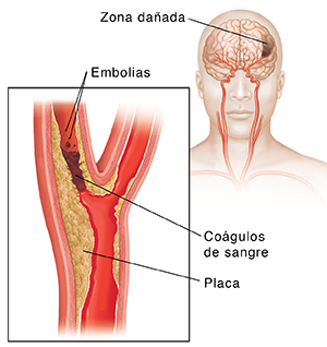 El coágulo sanguíneo bloquea una arteria carótida y los émbolos se desprenden del coágulo. El recuadro muestra el daño en el cerebro.
