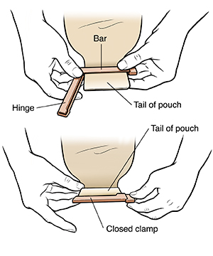 Hands closing clip on tail of ostomy pouch.