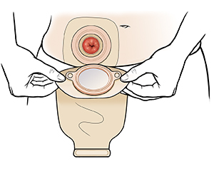 Hands placing ostomy pouch over stoma.