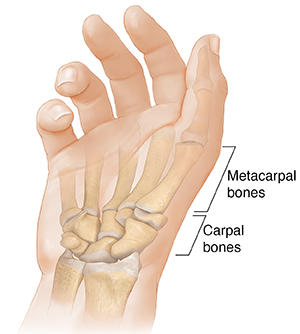 Palm view of hand showing metacarpal and carpal bones.