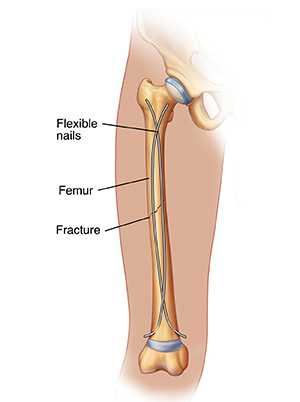 Outline of thigh showing fracture in femur and internal fixation hardware.