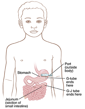 Front view of child with port outside belly and tube going through skin. G-tube goes into stomach. G-J tube ends in jejunum.