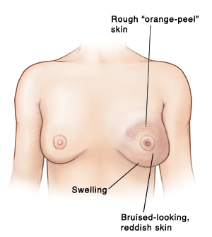 Front view of woman's chest showing swelling, rough orange-peel skin, and bruised-looking, reddish skin on one breast. That breast has inverted nipple. Other breast is normal.