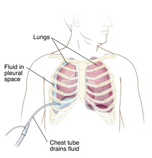 Fluid trapped between collapsed lung and body wall with tube inserted into chest between ribs removing fluid in pleural space..