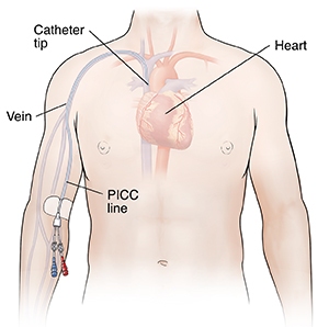 Outline of torso showing catheter with two ports placed in right arm and catheter tip in heart.