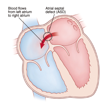 Front view cross section of heart showing atrial septal defect (ASD) allowing blood to flow from left atrium to right atrium.