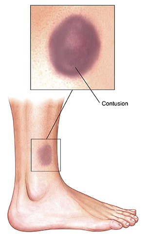 Side view of lower leg showing contusion on skin. Inset shows closeup of contusion.