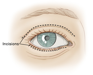 Front view of eye showing dotted line on top eyelid and dotted line underneath lower lashes for eyelid surgery.
