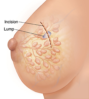 Side view of female breast with ducts and lobules ghosted in. Dotted line over lump shows incision for surgical biopsy.