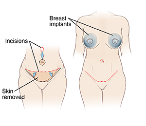 Two images of female abdomen: First image shows incisions and tissue removed for abdominoplasty. Second image shows final result of abdominoplasty plus breast implants.
