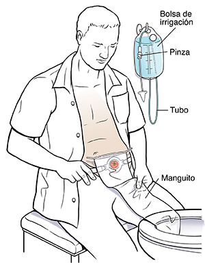 Hombre sentado junto al inodoro con el extremo de la bolsa de colostomía colocada sobre el borde de la taza del inodoro. Hay una bolsa de irrigación y una manguera que cuelgan de un gancho en la pared.